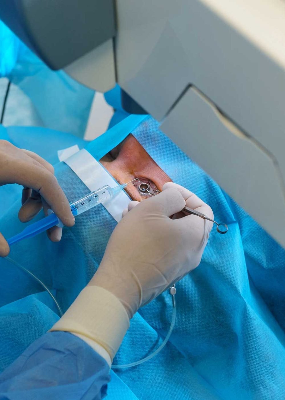 TRANSPLANTE-DE-CORNEA