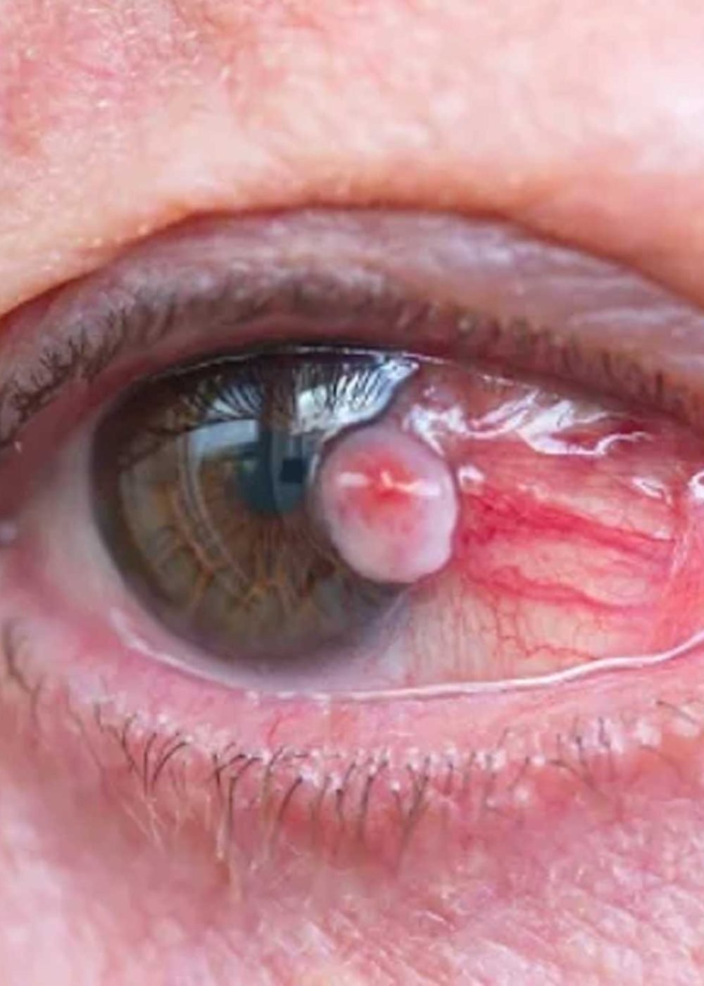 TUMORES-DE-SUPERFICIE-OCULAR